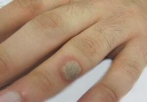 Papilloma a kefén