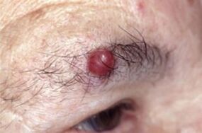 Papilloma a szemöldökön