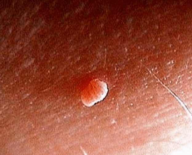 Papilloma a testen