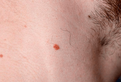 Papilloma