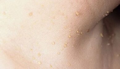 papillomatosis kialakulásának kockázata a nyakon