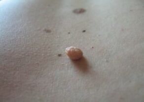A papilloma a bőr felszínén kialakuló növekedés