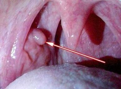 Papilloma a torokban