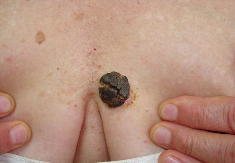 keratoma az emberi testen