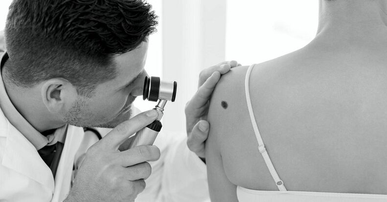 szakember diagnosztizálja a szemölcs típusát
