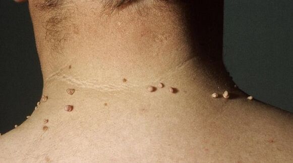 filiform papilloma a nyakon