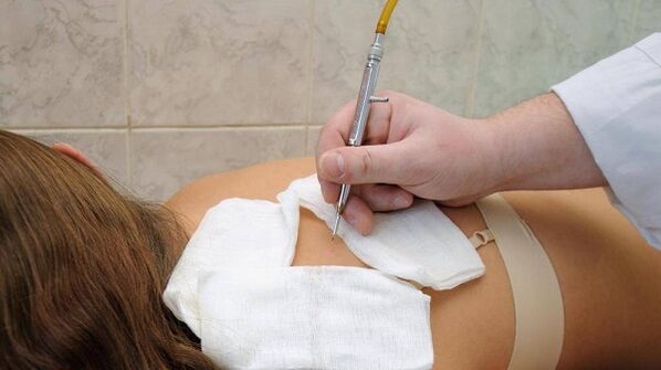 papilloma elektrokoagulációja a háton